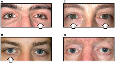 Apraclonidine Is Better Than Cocaine for Detection of Horner Syndrome